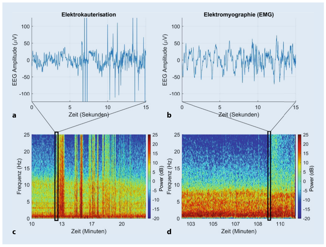 Roh-EEG und Spektrogramm mit den Mustern von Elektrokauterisation und Muskelaktivität
