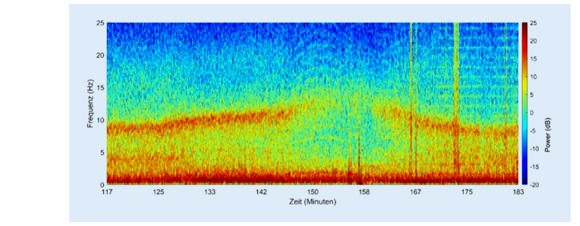 Langzeitspektrogramm über etwa eine Stunde während einer viszeralchirurgischen Operation mit Blutungskomplikation, mit zunächst kräftigem Alphaband, dessen Frequenz steigt und das später verschwindet