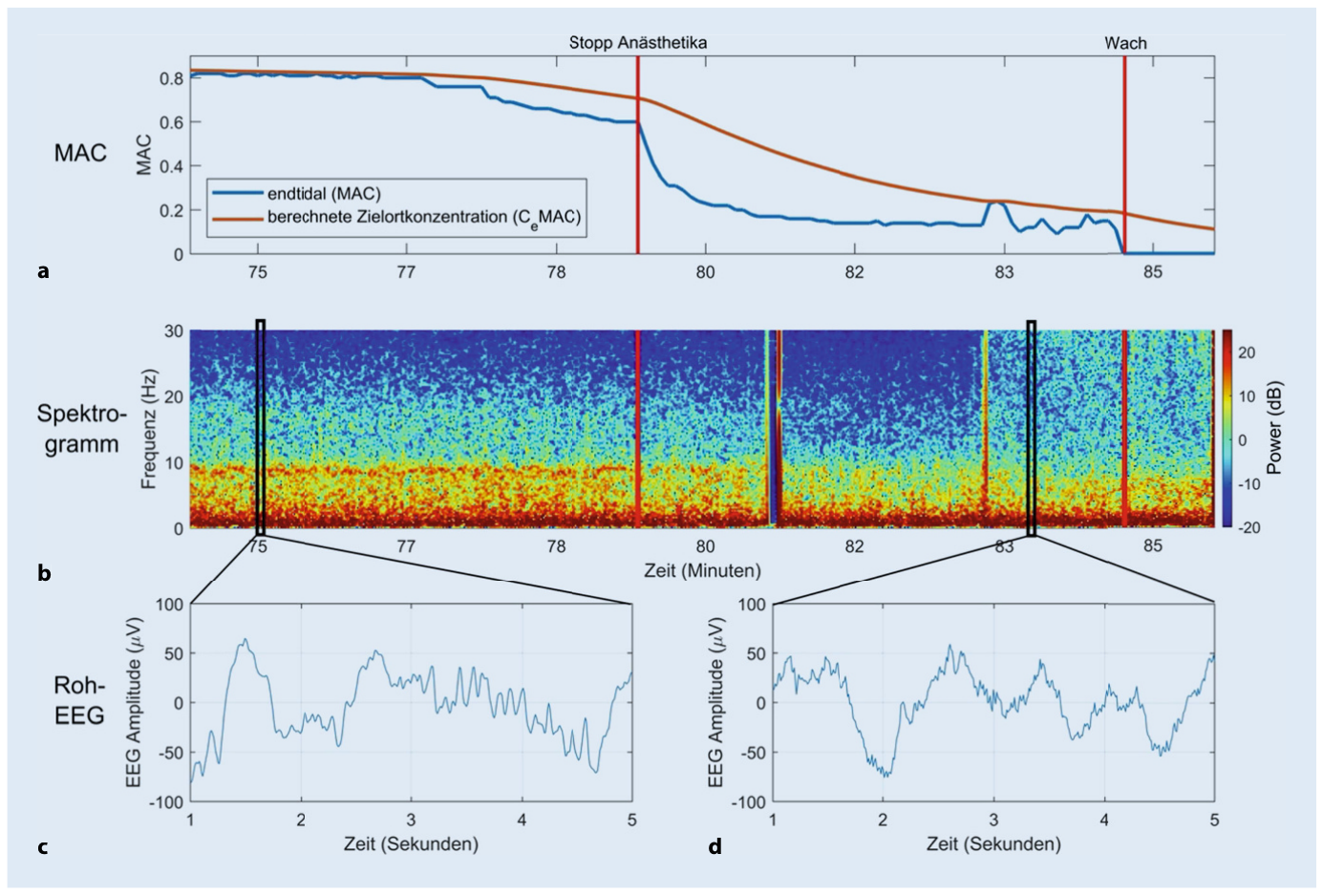 EEG-Verlauf beim Erwachen aus der Allgemeinanästhesie mit langsam zurückkehrender Aktivität trotz sinkender Anästhetikakonzentration