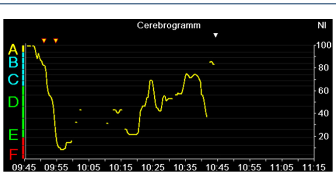 Verlauf von Narcotrend-Index und Stadien über eine Operation als Cerebrogramm
