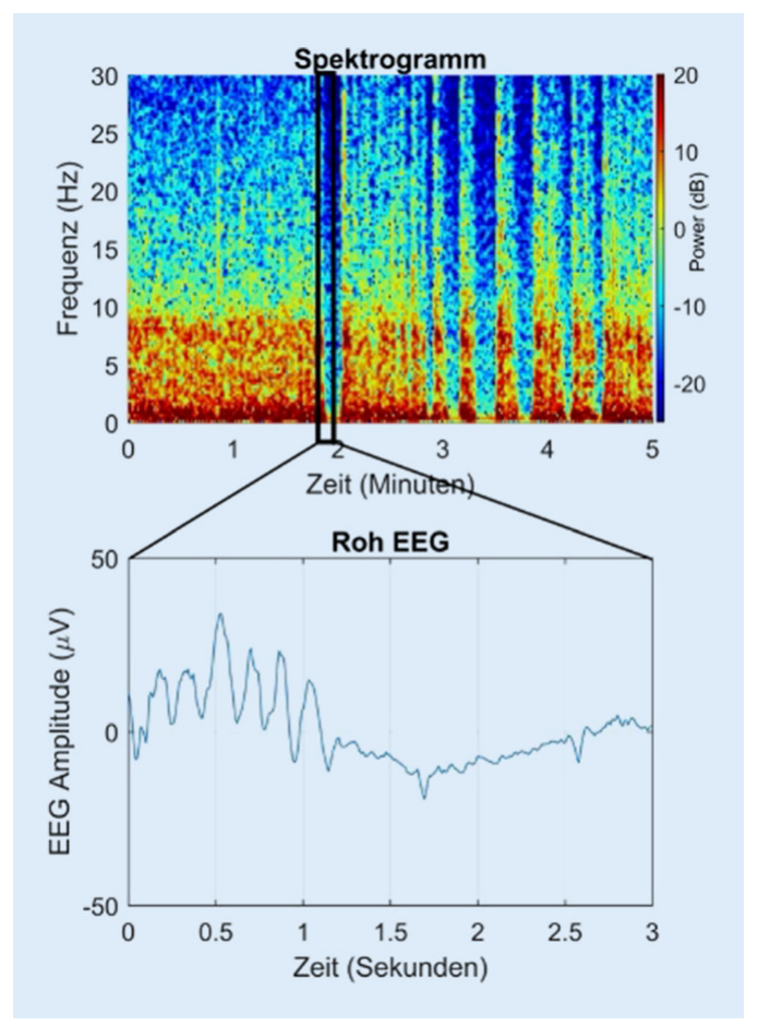 Spektrogramm und darunter ein herausvergrößerter Ausschnitt des Roh-EEG eines Patienten zu Beginn einer laparoskopischen Cholezystektomie bei einer minimalen alveolären Konzentration von 0,9