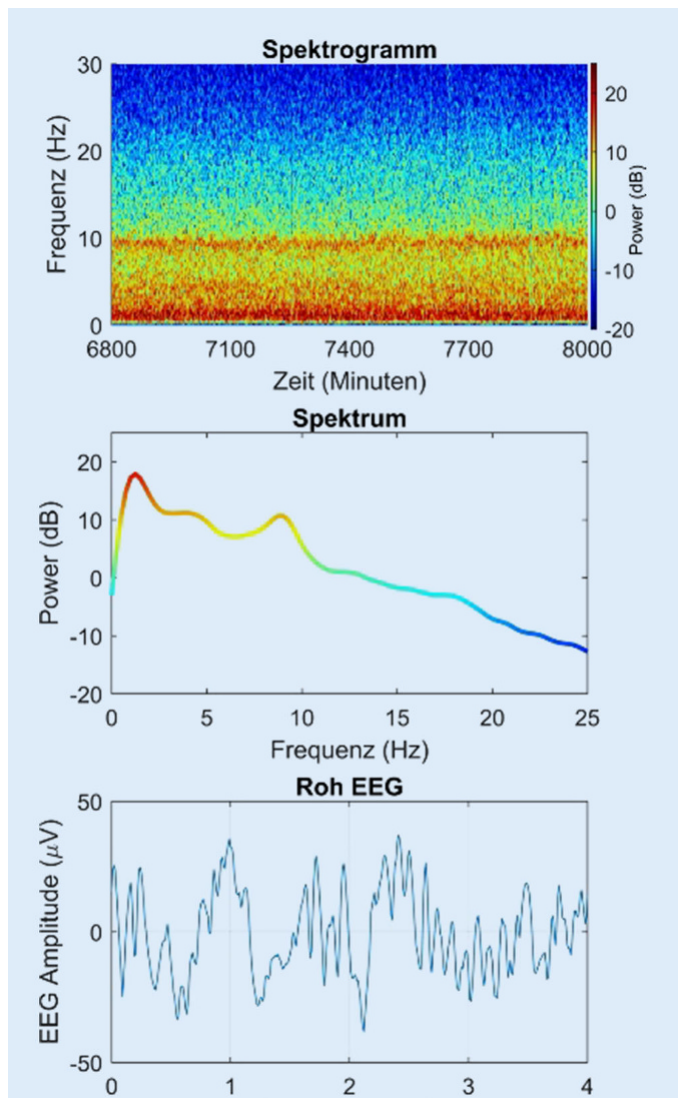 Spektrogramm, zugehöriges Spektrum und Roh-EEG desselben Abschnitts bei einer Sevoflurankonzentration um MAC 0,6