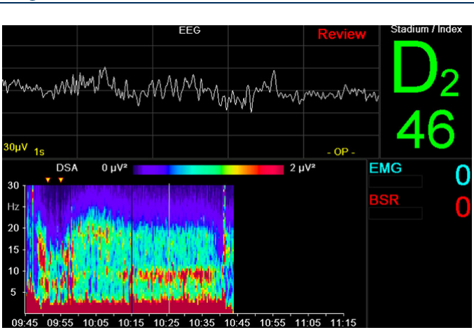 Bildschirm eines Narcotrend-Monitors mit Roh-EEG, Density Spectral Array, Stadienangabe, Index sowie Angaben zu Muskelaktivität und Suppression
