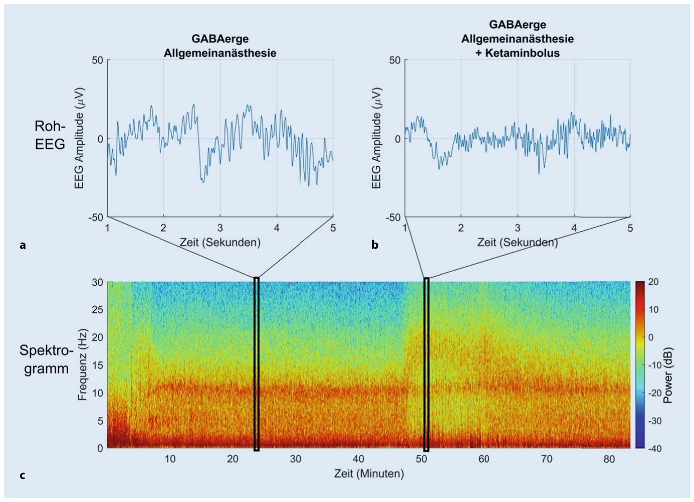Roh-EEG vor und nach einem Ketaminbolus unter laufender Sevoflurannarkose mit zugehörigem Spektrogramm