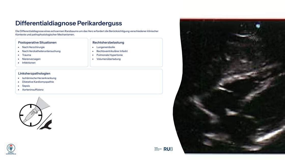 Folie 19: Differentialdiagnose Perikarderguss