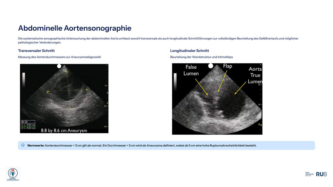 Folie 44: Abdominelle Aortensonographie