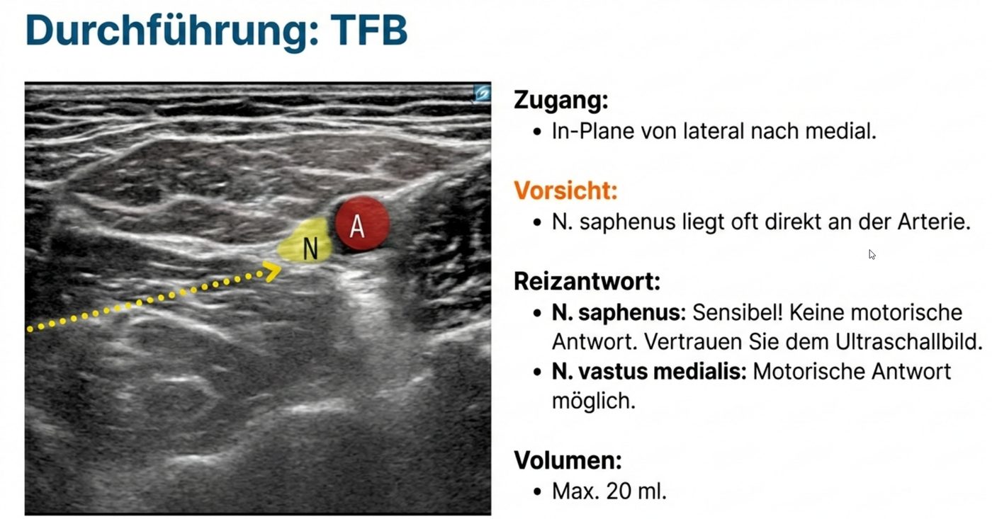 Durchführung des distalen Trigonum-femorale-Blocks