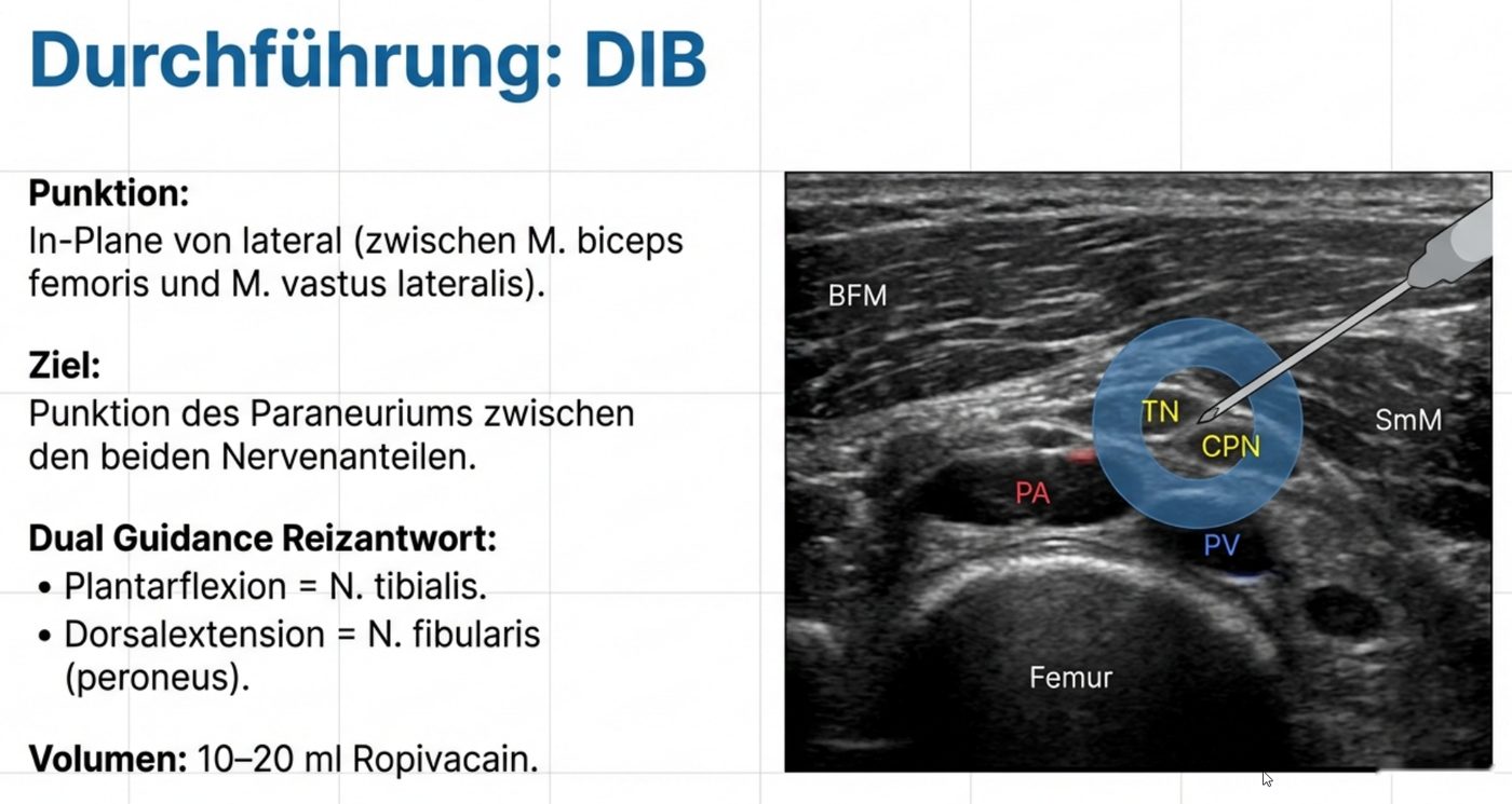 Durchführung des poplitealen Ischiadicusblocks